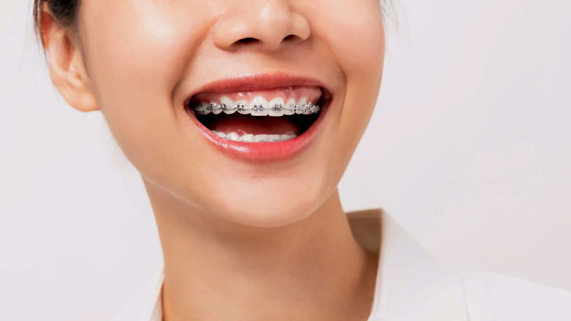 Orthodontie: Metalen Monden
